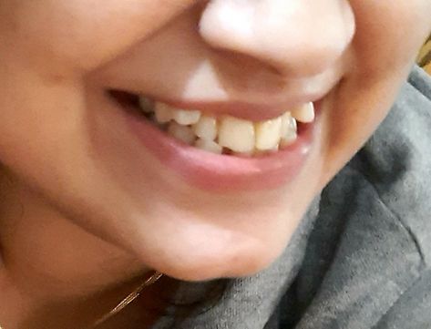 Crocked Teeth Smile, Crooked Teeth Smile, Crooked Teeth Aesthetic, Yaeba Teeth, Toothy Smile, Teeth Aesthetic, Buck Teeth, Crooked Smile, Crooked Teeth