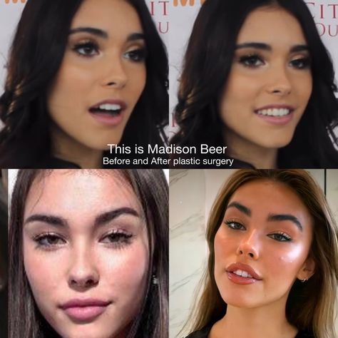 Madison Beer tiktok plastic surgery natural face vs after fillers and surgeries Plastic Surgery Transformation, Madison Beer Subliminal Results, Madison Beer Nose Profile, Madison Beer Plastic Surgery, Madison Beer Face Morph, Madison Beer Bare Face, Plastic Surgeon, Madison Beer, Perfect Woman