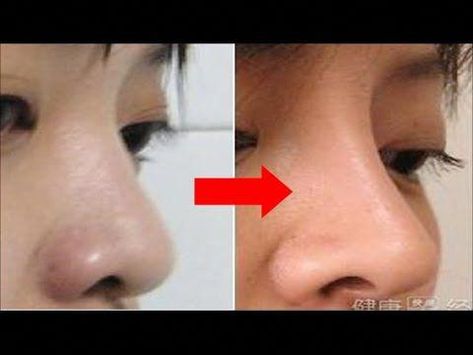 💃"Is it possible to change the shape of my nose?" "Can you send me a pose to reshape my nose?"I have received a lot of requests and questions about the nose... High Bridge Nose, Nose Reshaping, Rhinoplasty Before And After, Wide Nose, Nose Shapes, Bohemian House, Before Baby, Oral Health Care, Workout Pictures