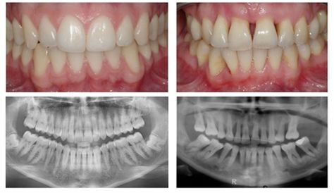 Dentaltown - Left side has Healthy Gums - Right side has Periodontal Disease Dental World, Dental Hygiene School, Dental Fun, Dental Facts, Dental Life, Bone Loss, Dental Humor, Periodontal Disease, Pediatric Dentistry