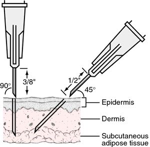 intravenous injection - definition of intravenous injection by Medical dictionary Subcutaneous Injection Sites, Intradermal Injection, Intramuscular Injection Sites, Injection Sites, Intravenous Injection, Nursing Study Tips, Subcutaneous Injection, Medical Assistant Student, Nursing Cheat