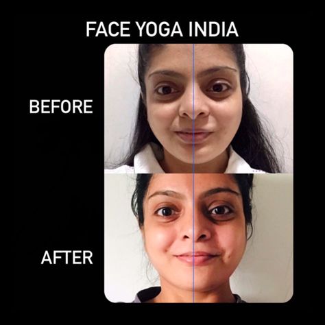 Girl with face asymmetry, cheeks drooping and eyes, fixed with face yoga Face Asymmetry, Side Of Face, Yoga India, Delicious Family Meals, Juice Diet, One Eye, Face Yoga, Wait For It, One Sided