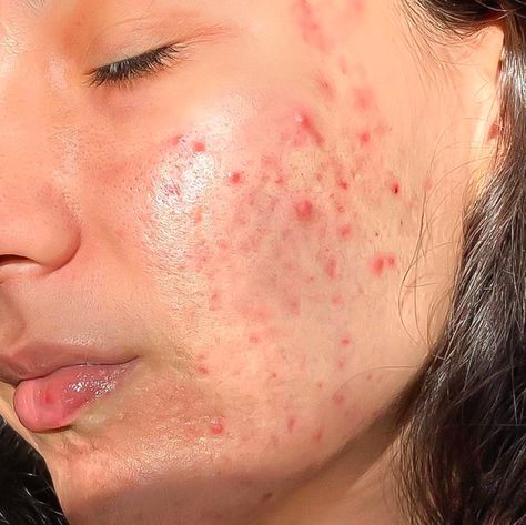 Acne Photoshoot, Human Imperfection, Acne Photography, Acne Aesthetic, Acne Photos, Girl With Acne, Acne Positivity, Skin Positivity, Best Dark Spot Corrector