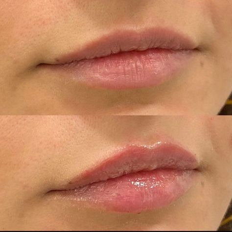 Cupid's Bow Lips, Cupids Bow Lips, Cupid's Bow, Lip Augmentation, Cupids Bow, Plastic Surgeon, The Face, Facial, Lips