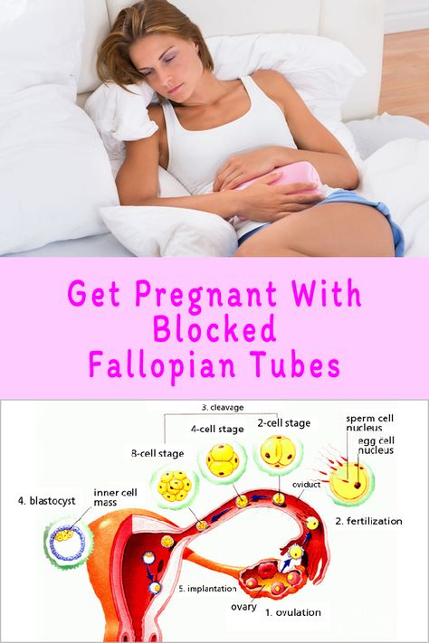 Real result to getting pregnant quickly and naturally: Get Pregnant With Blocked Fallopian Tubes Fallopian Tube Blockage, Blocked Fallopian Tubes, Fertility Yoga, Fertility Health, Get Pregnant Fast, Fallopian Tubes, Trying To Get Pregnant, Get Pregnant, Scar Tissue