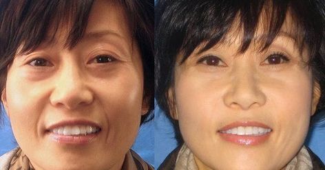 Nasolabial furrows grow deeper with time. As jowls droop and subcutaneous fat recedes with age on the cheeks, dimples expand to furrows, an... Nasal Folds, Tightening Workout, Smile Wrinkles, Face Training, Face Lift Exercises, Mouth Wrinkles, Gymnastics Routines, Anti Wrinkle Mask, Marionette Lines