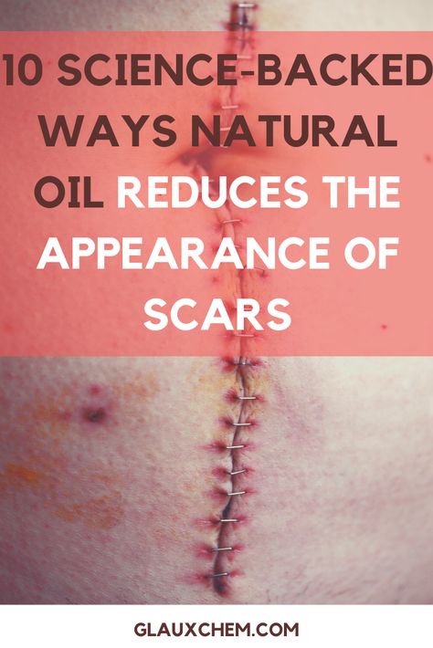 Scar Healing Remedies, Best Acne Scar Removal, Getting Rid Of Scars, Scar Remedies, Face Acne Treatment, Oils For Scars, Facial Scars, How To Fade, Lighten Scars