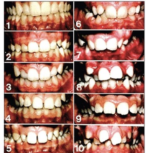 teeth Human Teeth Reference, Shark Teeth Drawing Reference, Teeth Horror Art, Teeth Falling Out, Teeth Aesthetic Creepy, Teeth Art Reference, Good Vs Evil Art, Showing Teeth Pose, Yaeba Teeth