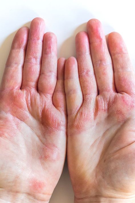 No, stress won’t exactly cause atopic dermatitis, the condition known as eczema. Learn why and read about other common misconceptions surrounding the rashlike condition. Contact Dermitis Hands, Atopic Dermitis Remedy, Arts Portfolio, Common Diseases, Heat Rash, Hand Protection, Medical Facts, Dry Itchy Skin, Bunny Wallpaper