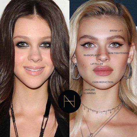 Best of Cosmetic Dermatology on Instagram: “What do you think of this transformation? I disagree with the brow lift... . . But otherwise I think this is spot on. Nicola Peltz looks…” Nicola Anne Peltz, Chin Reduction, Forehead Lift, Rhinoplasty Nose Jobs, Botox Lips, Face Surgery, Botox Face, Facial Surgery, Nicola Peltz