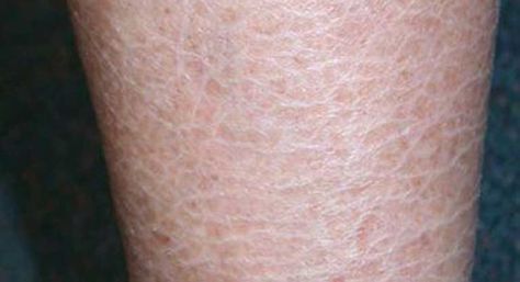 Ichthyosis Vulgaris-"fish-scale disease" occurs when your skin doesn't shed its dead skin cells Dry Skin Legs, Ichthyosis Vulgaris, Dry Scaly Skin, Dry Legs, Scale Skin, Extremely Dry Skin, Dry Flaky Skin, Skin Care Routine For 20s, Scaly Skin