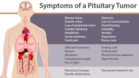 ‪#‎PituitaryTumor‬ is an abnormal growth in the pituitary gland which is the part of the brain that regulates the body’s balance of hormones. Pituitary gland produces many important hormones of the body. Pituitary Adenoma, Pituitary Gland Tumor, Pituitary Tumor, Brain Tumors, Nursing Mnemonics, Pituitary Gland, Migraine Relief, Anatomy Physiology, Endocrine System