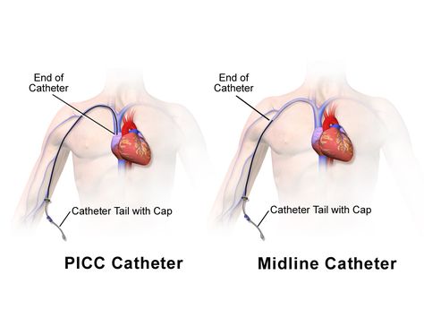 PICC LINE VS MIDLINE CATHETER Picc Line Vs Midline, Picc Line Nursing, Nursing Basics, Picc Nurse, Pharmacy Notes, Nurse Purse, Er Nursing, Nursing Inspiration, Central Venous Catheter