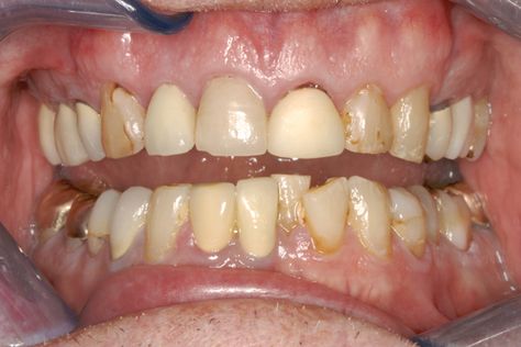 Balancing Opacity and Translucency for Life-Like Esthetics | Inside Dentistry Tooth Crown, White Smile, White Teeth, Dental Clinic, Glass Ceramic