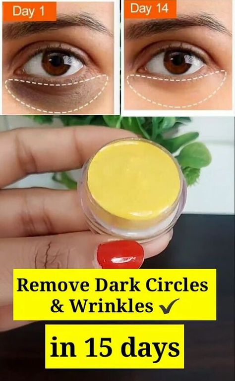 Wrinkles Under Eyes, Diy Eye Cream, Anti Aging Remedies, Wrinkle Remedies, Eye Wrinkles, Dark Eye Circles, Neck Wrinkles, Under Eye Puffiness, Under Eye Wrinkles