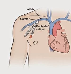 Central Venous Catheter, Central Line, Health Signs, Health Articles, Blood Vessels, Medical Care, Blood Flow, Wellness Tips, Healthcare Professionals