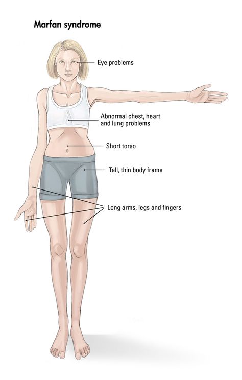 Marfan syndrome is a disorder involving the body’s connective tissue. A defective (FBN1) gene associated with Marfan syndrome affects the formation of a protein in connective tissue called fibrillin, which impacts the integrity of many organs and structures in the body.According to the March of Dimes, more than 200,000 people in the U.S. are affected by Marfan syndrome. Marfan syndrome occurs in equal numbers in males and females, and also appears equally in all races and ethnic groups. Marfans Syndrome, Jeans For Genes Day, Jeans For Genes, March Of Dimes, Nursing Mnemonics, Family Nurse Practitioner, Nursing School Notes, Connective Tissue, Medical Studies