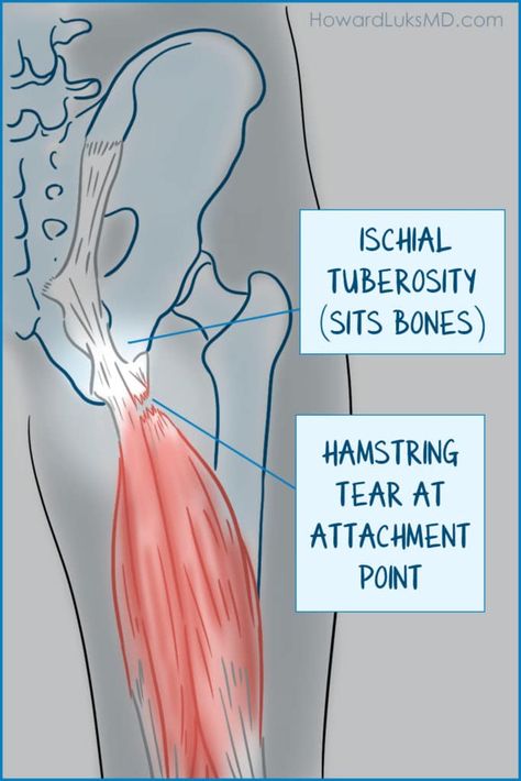 Ischial Tuberosity Bursitis, Core Activation, Hip Health, Torn Hamstring, Hamstring Injury, Human Muscle Anatomy, Bursitis Hip, Hamstring Muscles, Collagen Fibers