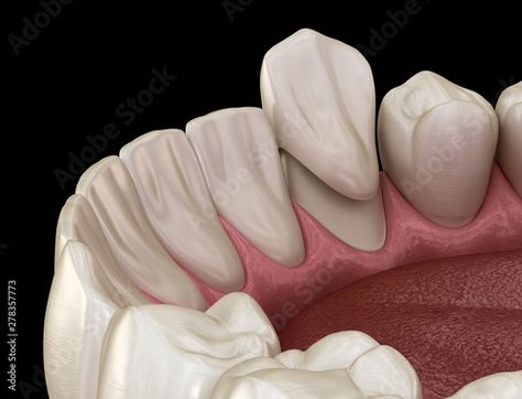 Canine Tooth, Dental Crowns, 3d Illustration, Adobe Stock, Stock Illustration, Stock Images, Crown, Illustrations