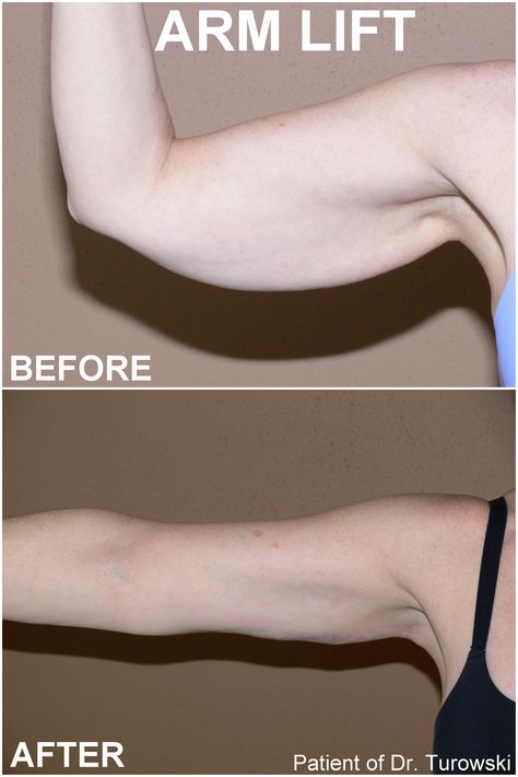 Arm Surgery Plastic Before After, Skin Removal Surgery Before And After, Thigh Lift Before And After, Mommy Makeover Surgery Recovery, Arm Surgery, Body Lift Surgery, Arm Lift Surgery, Skin Removal Surgery, Body Plastic Surgery