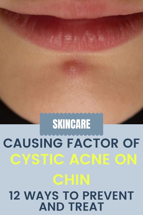 Causing Factor Of Cystic Acne On Chin - 12 Ways To Prevent And Treat Chin Breakouts, Chin Acne Causes, Cystic Acne On Chin, Painful Pimple, Painful Acne, Chin Acne, Cystic Pimple, Prevent Pimples, Baking Soda Cleaning