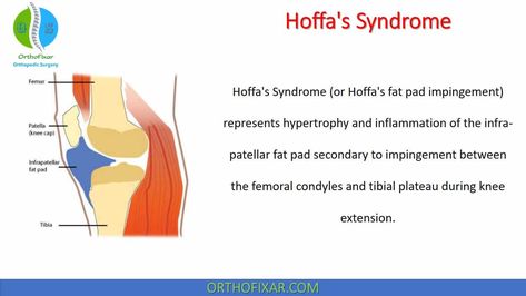 Hoffa's Syndrome (or Hoffa's fat pad impingement) represents hypertrophy and inflammation of the infra-patellar fat pad secondary to impingement between the femoral condyles and tibial plateau during knee extension. It's sometimes called Infrapatellar fat pad syndrome. This syndrome was first described by Hoffa in 1904. See Also: Homans Sign Hoffa's fat pad impingement Fat Pads Anatomy There are three fat pads located at the anterior knee: The quadriceps fat pad, The ... Homans Sign, Synovial Fluid, Musculoskeletal Pain, Knee Cap, Magnetic Resonance, Adipose Tissue, Sports Medicine, Knee Pain, Anatomy