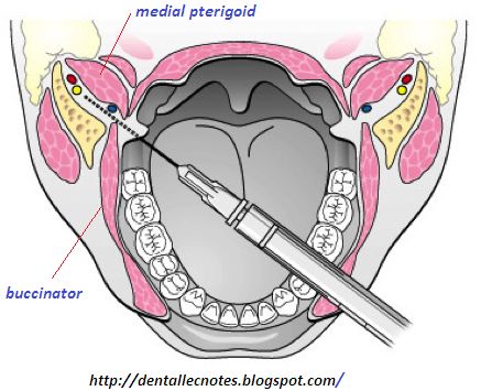 Dental Anesthesia, Dental Assistant Study, Registered Dental Hygienist, Dental Hygiene Student, Dental Videos, Dental Photography, Kedokteran Gigi, Dental Hygiene School, Dentistry Student