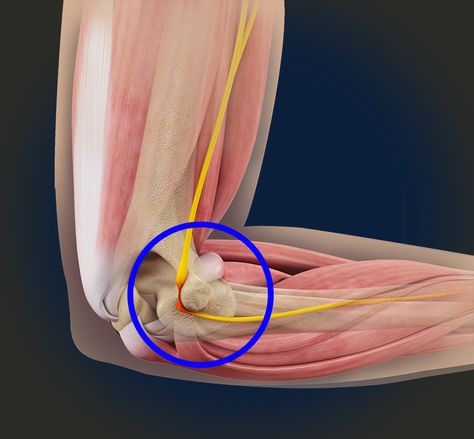 Most people have heard of "golfer's elbow," but most people haven't heard of ulnar nerve entrapment. The ulnar nerve courses around the inside of the elbow and is a common problem with weightlifters, golfers, and professionals that do most of their work on the computer. It can be diagnosed and fixed entirely by experts like us without surgery or unnecessary injections. Ulnar Nerve, Golfers Elbow, Wrist Pain, Golfers, Nerve, Professions, Surgery, Computer