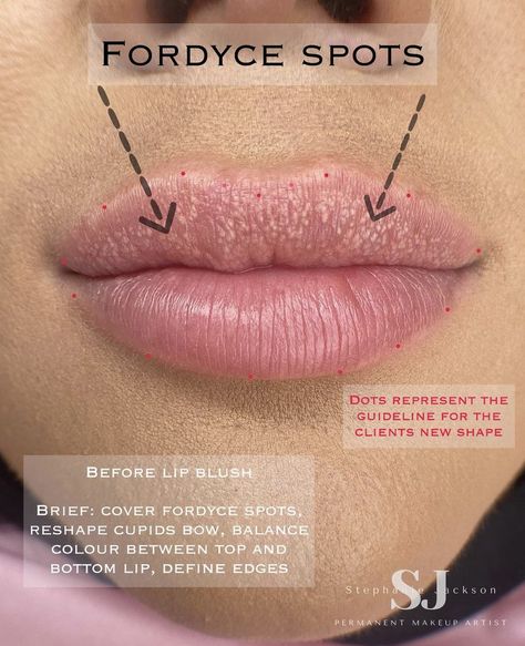 Lip Injections Inspiration, Hyaluron Pen Lip Mapping, Lip Blushing Tattoo Before And After Colors, Lips Injections Shapes, Lip Border Definition Filler, Instagram Tutorial, Bottom Lip, Botox Fillers, Cupids Bow