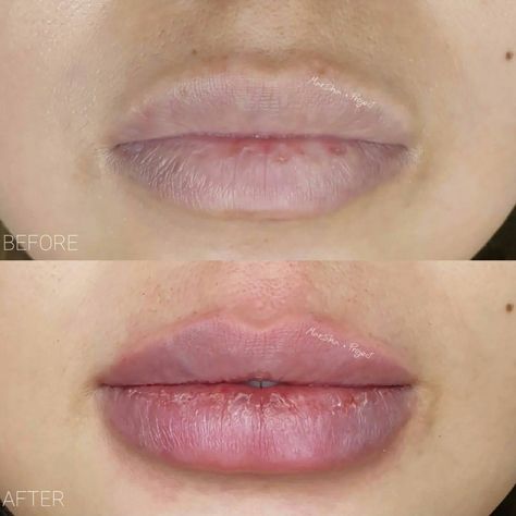 🔑 A lip filler technique where the lips are filled with a small gap in the center where the top and bottom lip meet that looks like a “keyhole”. 👄 Lip enhancement procedure using HA fillers which aims to boost lip volume, enhance lip shape, and smooth vertical lip lines (perioral rhytids). 💉 Lip fillers is a minimally invasive cosmetic procedure which involves injecting HA fillers into the lip for plumper and smoother effect with fast recovery time than surgery and  last for 6 to 12 mos. Keyhole Lips, Lip Filler Technique, Lip Augmentation, Lip Filler, Lip Enhancement, Bottom Lip, Lip Shapes, Cosmetic Procedures, Lip Fillers