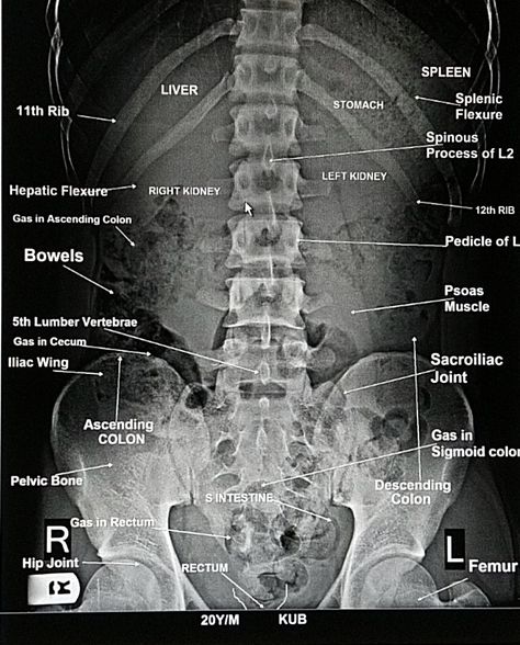 Abdomen Xray, Radiography Student, Radiology Schools, Charting For Nurses, Medical Radiography, Radiologic Technology, Radiology Student, Radiology Technician, Diagnostic Medical Sonography