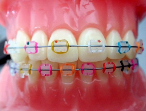 Showing the different color options paired with ceramic brackets Clear Braces With Color Bands, Braces Colours, Braces Colors Combinations, Baking Soda Lemon Juice, Braces Bands, Ceramic Braces, Baking Soda Teeth Whitening, Cute Braces Colors, Teeth Whitening Procedure