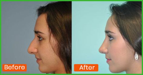 Sharp nose is a symbol of beauty and it fits in with any make up look too. Nose reshape exercises can help improve the shape! Here are top exercises for nose shape How To Reshape Your Nose, Reshape Nose, Make Nose Smaller, Sharp Nose, Nose Reshaping, Facial Yoga, Breast Workout, Makeup Help, Nose Shapes