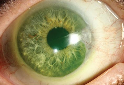 Review of Cornea and Contact Lenses > Seven Simple Secrets to Scleral Success Scleral Contact Lenses, Scleral Lenses, Contact Lenses Tips, Corneal Transplant, Eye Contact Lenses, Soft Contact Lenses, Soft Lens, Halloween Contacts, Dry Eyes