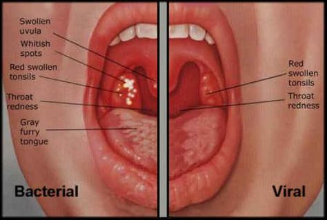 Image result for sore throat remedies fast Swollen Uvula, Throat Ulcers, Swollen Tonsils, Throat Remedies, Sore Throat Remedies, Low Sodium Recipes Blood Pressure, Throat Pain, Blood Pressure Symptoms, Throat Infection