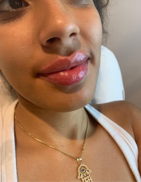 Upper Lip Filler, Lip Filler Before And After, Filler Inspiration, Face Fillers, Lip Filler, Beauty Hair Makeup, Lip Injections, Face Card, Upper Lip