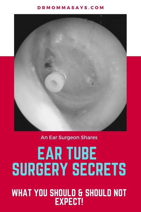 Ear Tube Surgery Secrets: What You Should and Should Not Expect - Dr Momma Says Fluid In Ears, Ear Tubes, Family Resources, Chronic Cough, Speech Delay, Toddler Stuff, Parenting Strategies, Staff Training, Family Ties