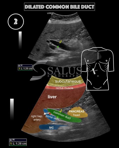 Ultrasound School, Medical Radiography, Gallbladder Stones, Sonography Student, Ultrasound Sonography, Medical Ultrasound, Diagnostic Medical Sonography, Bile Duct, Medical Anatomy