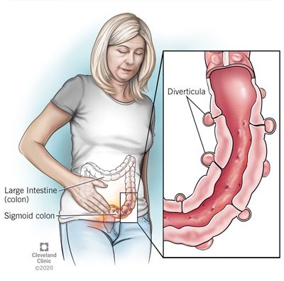 Diverticulos Foods To Avoid, Diverticulos Symptoms, Diverculitis Diet, Diverticular Diet, Diviticulitis Food List, Diverticulos Meals, Diviticulitis Diet, Mediterranean Foods, Gastric Problem