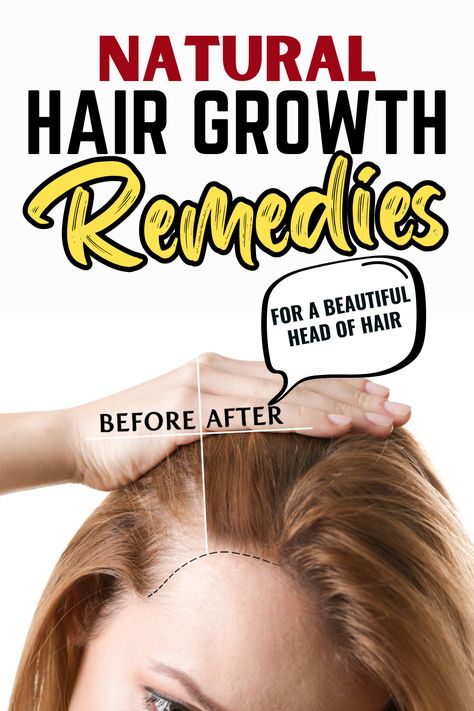 Natural Hair Growth Remedies for a Beautiful Head of Hair Hair Growth Remedies, Hair Growth Home Remedies, Natural Hair Growth Remedies, Accelerate Hair Growth, Male Fitness, Loss Hair, Greasy Hair, Hair Remedies For Growth, Home Remedies For Hair