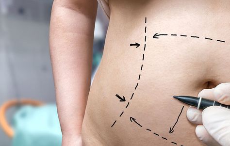 8 Things You Should Know About A Tummy Tuck—From Someone Who Got One Tummy Tucks Recovery, Mommy Makeover Surgery, Surgical Procedures, Plastic Surgery Procedures, Excess Skin, Mommy Makeover, Cosmetic Procedures, Tummy Tucks, Loose Skin