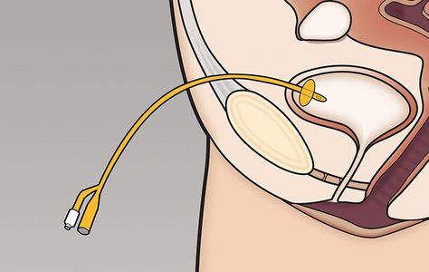 What is a suprapubic catheter? A suprapubic catheter is a hollow flexible tube that is used to drain urine from the bladder. It is inserted into the bladder through a cut in the tummy, a few inches below the navel (tummy button). This is done under a local anaesthetic or a light general anaesthetic. Why … Urinary Bladder, Urinary Bladder Diagram, Intersistial Bladder, Weak Bladder, Medical Transcription, Bladder Control, Primary Research, Urinary Tract, Research Studies