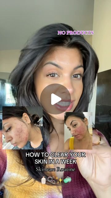 ANCI on Instagram: "I really didnt smile🤣🫶🏼👇🏼  The less you use the FASTER YOUR SKIN WILL HEAL. You will literally see your skin clear up in a week   #toxicfree #skinsta #skincareritual #skinhealth #fragrancefree #igskincare #bodyscrubs #naturalskincaretips #cleanbeauty #greenbeautyrevolution #skincareblogger #healthyskincare" How To Get Clear Skin Naturally, Get Clear Skin Naturally, Clear Skin Naturally, Get Clear Skin, Pele Natural, Clear Healthy Skin, Skincare Blogger, Skin Clear, Healthy Skin Care