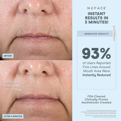 NuFACE Fix Line Smoothing Device Lines Around Mouth, Body Types Women, Bleach London, Tighter Skin, Hair Solutions, Smoother Skin, Puffy Eyes, Eyes Lips, Skin Firming