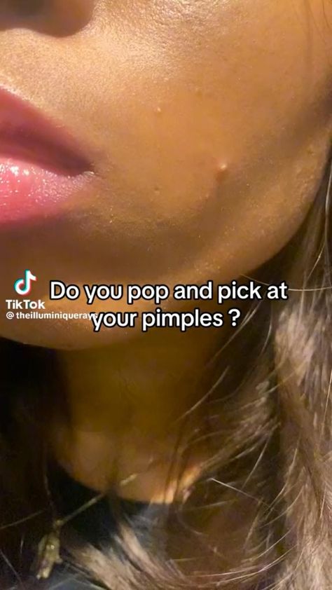 Get rid of pimples Face Acne Remedies, Pimple Hacks, Pimple Scar Removal, Getting Rid Of Scars, How To Clear Pimples, Pimple Scars, Regular Skin Care Routine, Pimple Marks, Get Rid Of Pimples