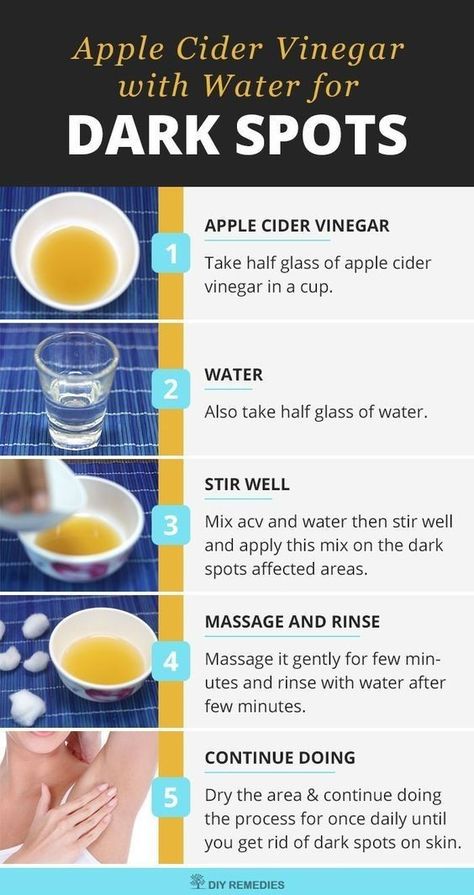 #skincare #skinremedies #skinhacks #homeremedies #naturalskincare Apple Cider Vinegar And Water, Hyperpigmentation On Face, Dark Spots Under Armpits, Get Rid Of Hyperpigmentation, Apple Cider Vinegar For Skin, Skin Care Routine For 20s, Dark Spots On Face, Dark Spots On Skin, Spots On Face