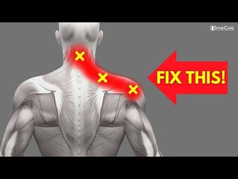 How to INSTANTLY Fix Pinched Nerve Pain in the Neck and Shoulders - YouTube Pinched Nerve In Shoulder, Shoulder Pain Remedies, Pinched Nerve In Neck, Neck Muscle Pain, Shoulder Muscle Pain, Trapped Nerve, Neck Pain Exercises, Sciatic Nerve Relief, Neck And Shoulder Exercises