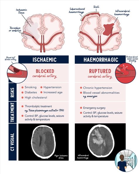 🧠 𝗤𝘂𝗶𝗰𝗸 𝗦𝘁𝗿𝗼𝗸𝗲 𝗢𝘃𝗲𝗿𝘃𝗶𝗲𝘄 🧠

Haemorrhagic 🆚 Ischaemic


#nursing #nursingnotes #nursingschool #nursingschoollife #nursingschoolnotes #registerednurse #LPN #ain #nurseeducator #stroke #ischaemicstroke #haemorrhagicstroke #studentnurse #studentnurses #thepreparednurseco Neuro Nursing, Concept Map Nursing, Nursing School Studying Cheat Sheets, Nursing School Life, Nurse Skills, Nursing Skills, Science Cells, Medical Study, Nursing 101