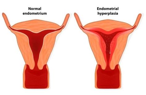 Operasi Caesar, Endometrial Hyperplasia, دورة شهرية, Mang Thai, Alternative Medicine, Herbal Remedies, Natural Remedies, Period