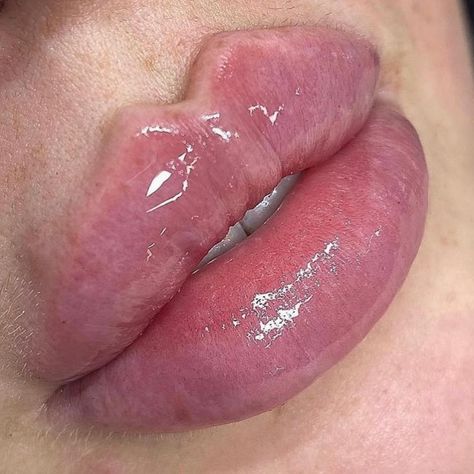 NO FILTER JUST FILLER 😍 APPOINTMENTS & TRAININGS available for lip filler services 😍 100% Hyaluronic Acid No Pain | No Downtime Natural Alternative Lasts 12 + Months With Proper Care 20-30 Min Procedure Lip Filler, Lip Fillers, No Filter, Shelf Life, Hyaluronic Acid, 12 Months, Vision Board, Filter, Lips